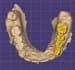 design professional dental cad crwonbridge using exocad