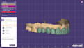 design crowns and bridges using exocad