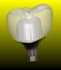 custom abutment on implants, screw retained