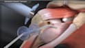 create medical device 3d surgery process explainer animation surgical simulation