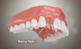 do 3d dental implant animation, patient education, explainer video
