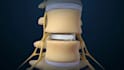 create professional 3d spine surgery orthopedic and medical animation