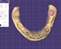 design professional dental cad cases using exocad