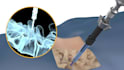 create3d medical device animation spine surgery orthopedic implant visualization