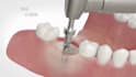3d dental animation dental implant socket procedure bone graft explainer video