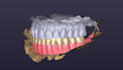 design functional and esthetic removable denture