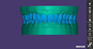 design dental crown and bridges using exocad
