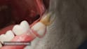 create 3d dental animation, dental procedure, dental implant and oral surgery