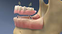 do 3d medical explainer 3d dental implant animation 3d dental surgical procedure
