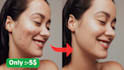 professional acne pimple blemish removal