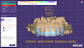 precise crown lengthening surgical guide