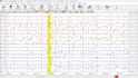 doeeg,ncv accurate report interpretation analysis and format