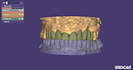 do precise dental cad cam designing for crowns and partial dentures