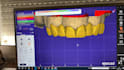 create professional dental cad designs with exocad