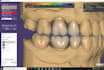 design dental crowns from stl scans using cad software