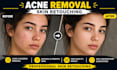remove pimples, acne, scars and skin blemishes