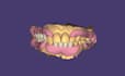 design crowns, bridges, implants, dentures using exocad
