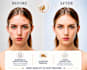 professionally remove pimples and blemishes