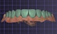 do crown and veneer design