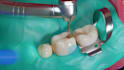 create dental implant animation caries removal and dental device explainer video