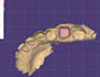 design dental crowns and bridges