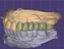 do exocad dental cad design for crowns, bridges and more