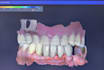 design crowns, bridges and implants professionally in exocad