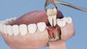 create 3d dental implants animation, dental surgery , oral procedures