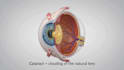 create 3d medical animation, 3d surgical animation, medical explainer video