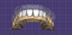 design natural looking dental veneers