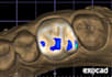 design smiles in exocad software for competing prices