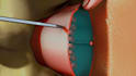 3d medical animation, surgery animation and medical explainer videos