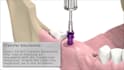 create 3d dental implant surgery and medical animation