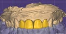 design bridges, implant prosthesis and all on x
