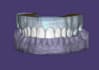 design aesthetic dental crown veneers and bridges using exocad