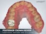 design anterior and posterior dental crowns using 3shape
