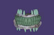 all on x full arch implant prostheses using exocad