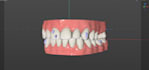 design complete clear aligner treatment plans