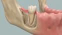 create 3d dental implant animation and medical explainer video
