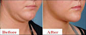 remove double chin from your face in 2 hours