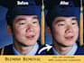 remove acne and scars from your photos