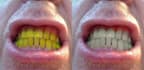 clean and fix yellow teeth with photoshop