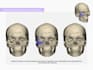 do  3d maxillofacial reconstruction and craneal prosthesis