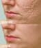 remove your acne marks, pimples, dark circles, and eye bags