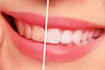 white your teeth and remove stains quickly