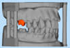 design dental appliances for you using exocad and 3shape software