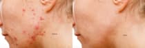 remove wrinkles, blemishes, spots, pimples from your skin