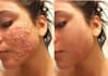 remove pimples from your images