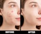 remove your 15 image pimples and brightens it within 1 day