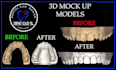 design   smile design, mockup, snap on smile  with exocad